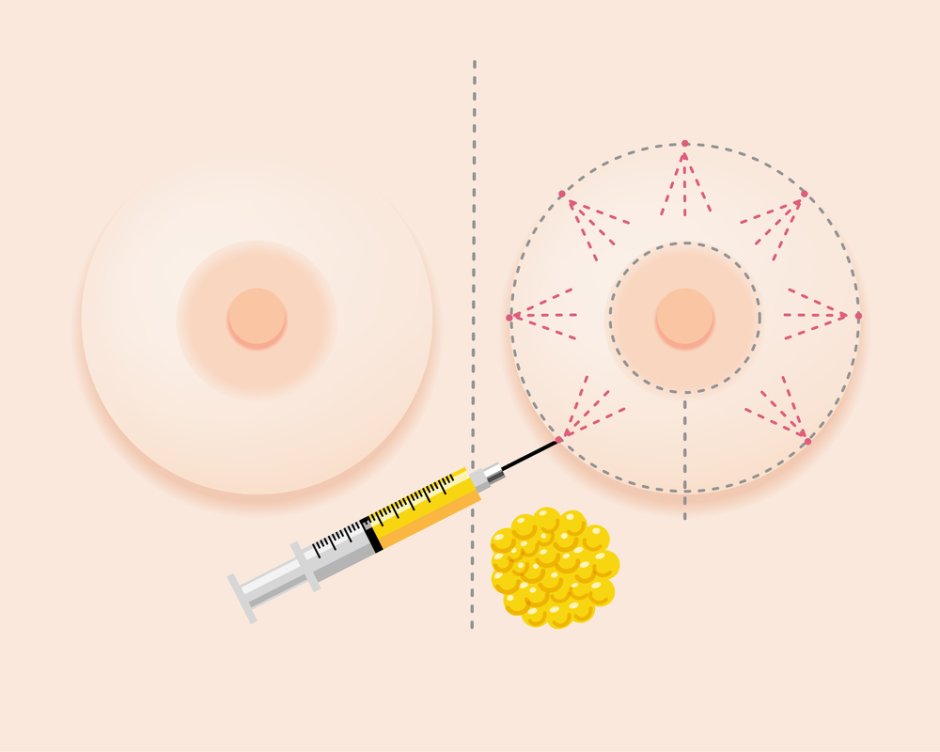 Reduce a large breast forum