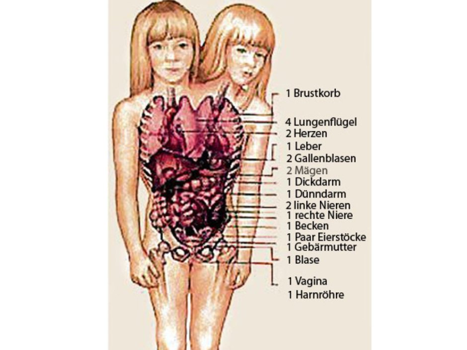 Sisters Hensel Anatomy