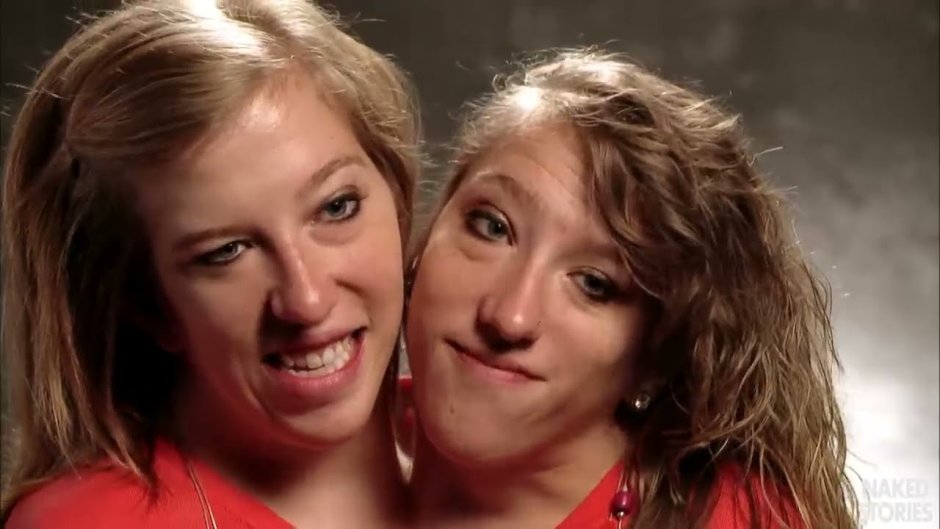 Abby and Brittany Hensel Gemini