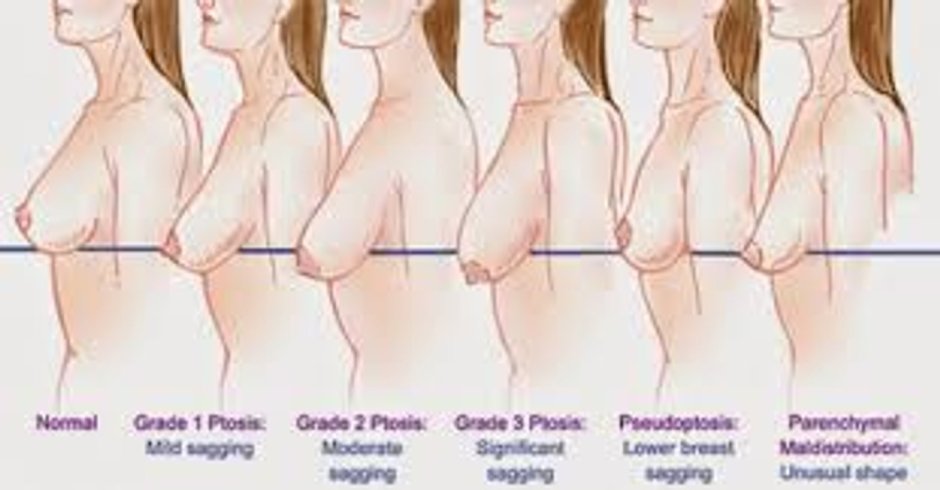 Stages of sagging breasts