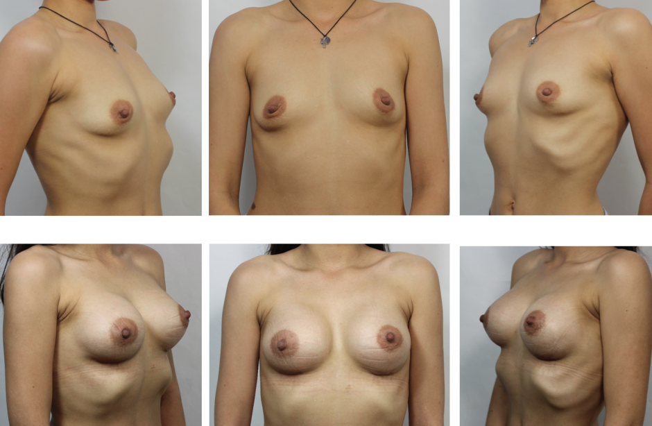 Varieties of female breast