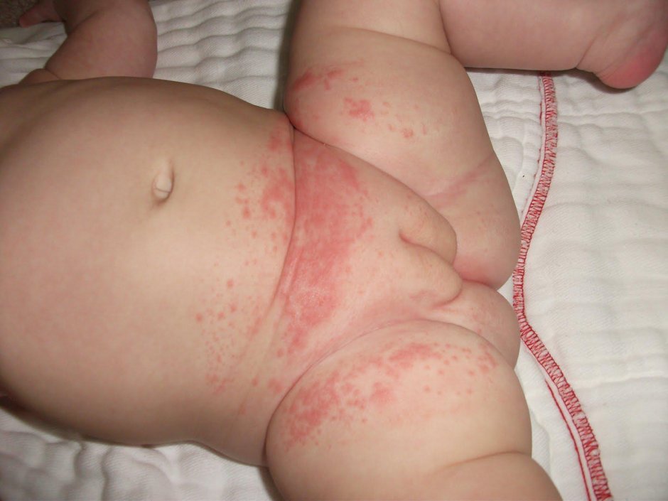 Diaper dermatitis by baby
