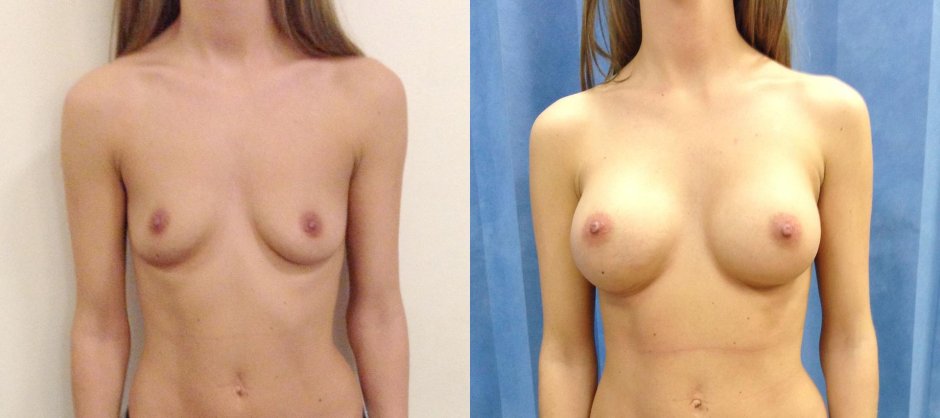 Naked boobs in different directions