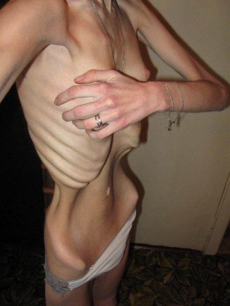 Naked thin anorexics