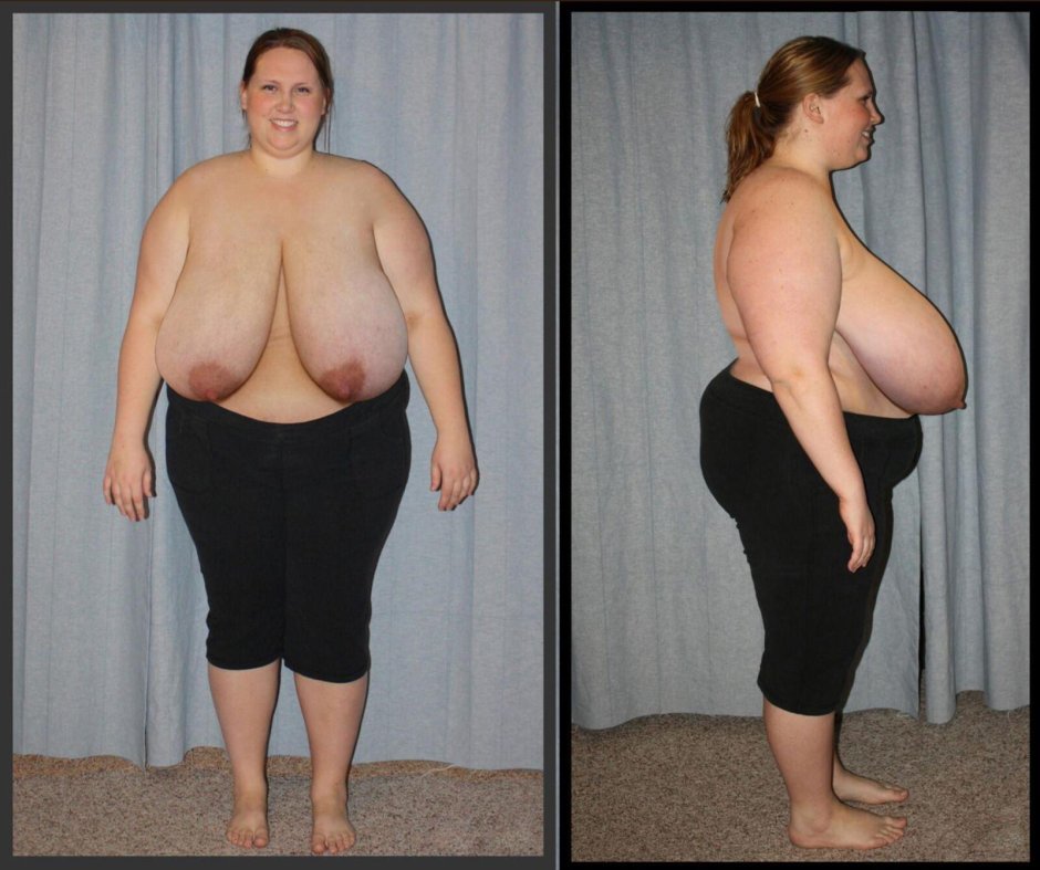 Hypermastia macromastia