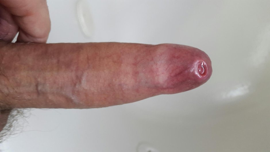 Hypertrophic phimosis