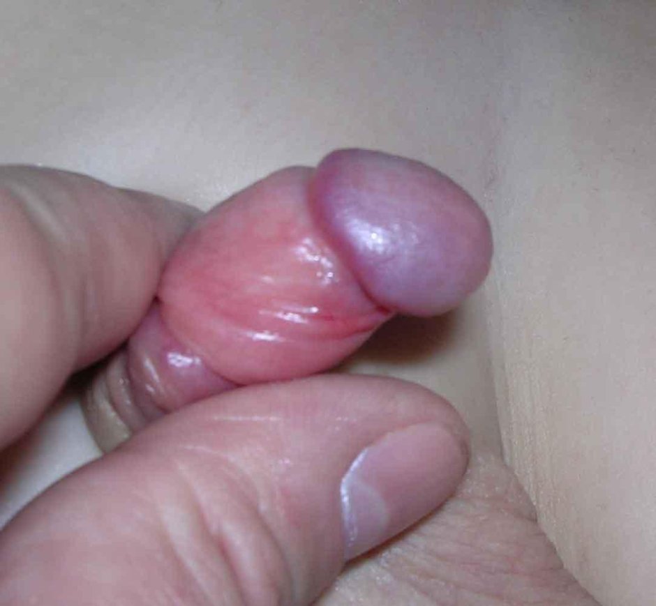 Hypertrophic phimosis