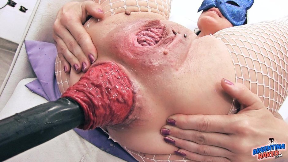 Extreme anal fisting